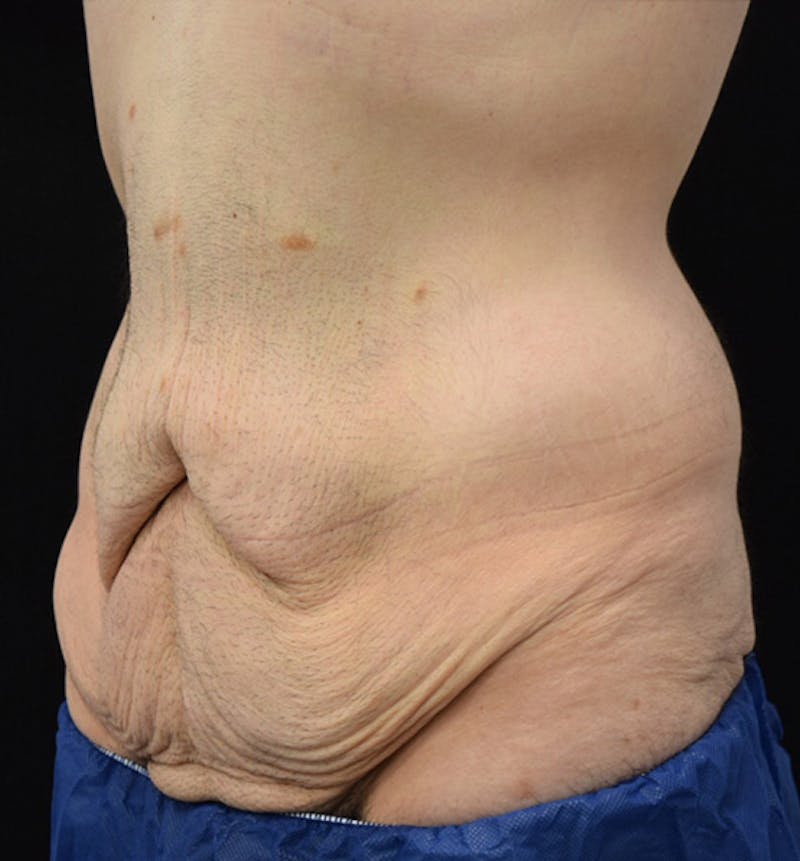 Male Lower Body Lift Before & After Gallery - Patient 148037520 - Image 7