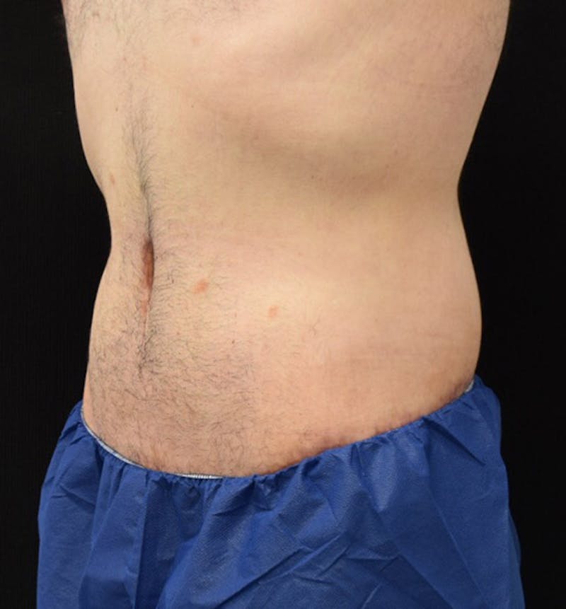 Male Lower Body Lift Before & After Gallery - Patient 148037520 - Image 8