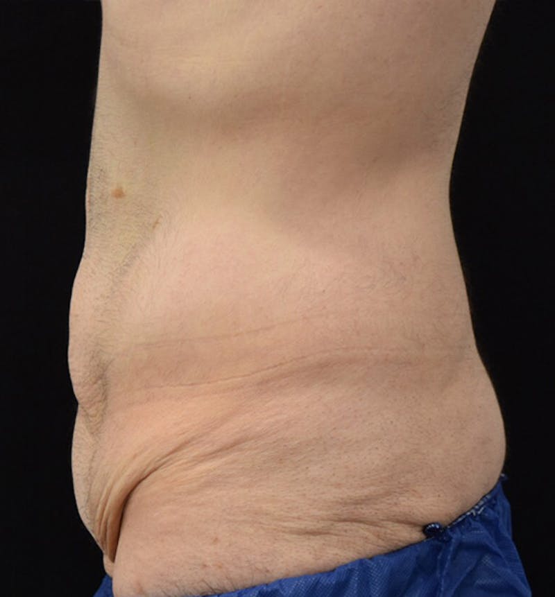 Male Lower Body Lift Before & After Gallery - Patient 148037520 - Image 9