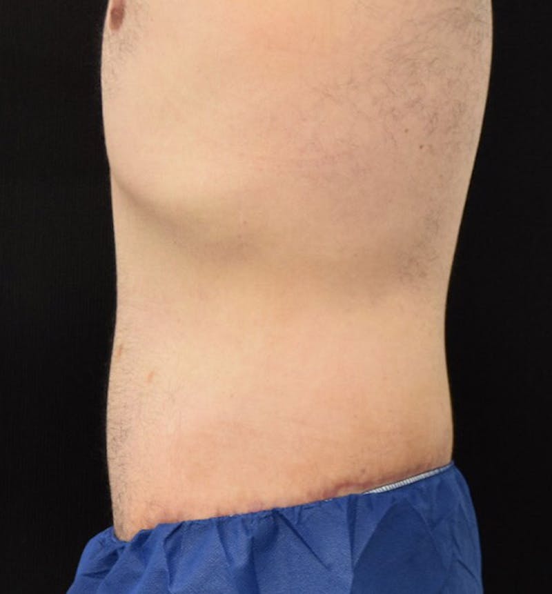 Male Lower Body Lift Before & After Gallery - Patient 148037520 - Image 10