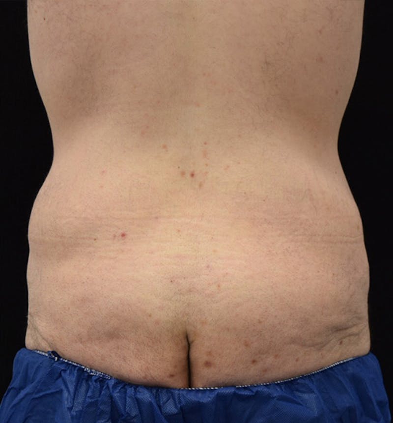 Lower Body Lift Before & After Gallery - Patient 148037520 - Image 11