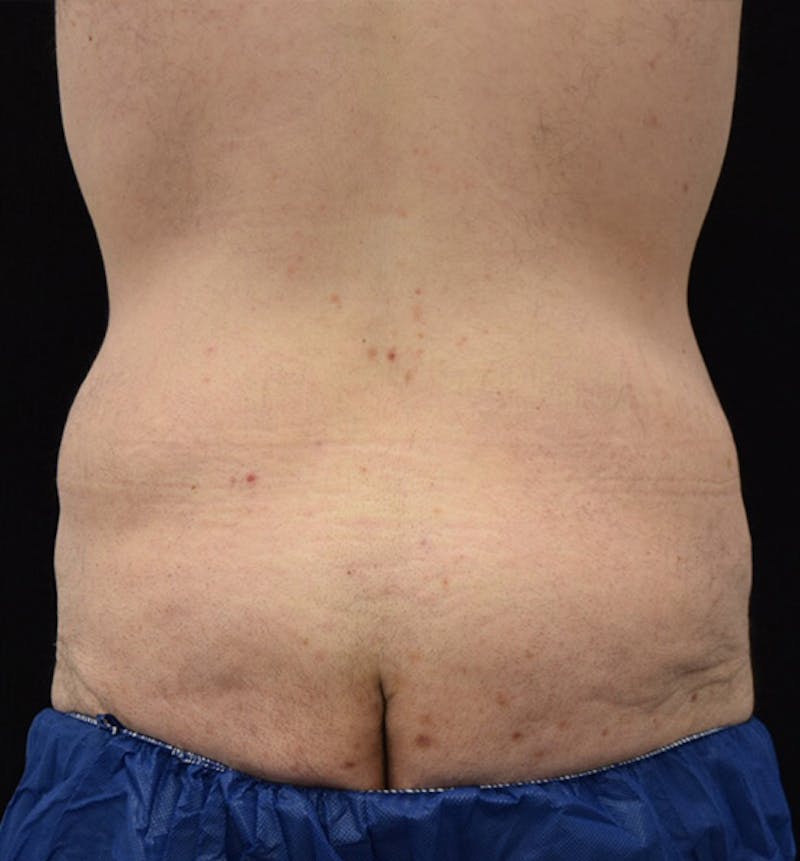 Male Lower Body Lift Before & After Gallery - Patient 148037520 - Image 11
