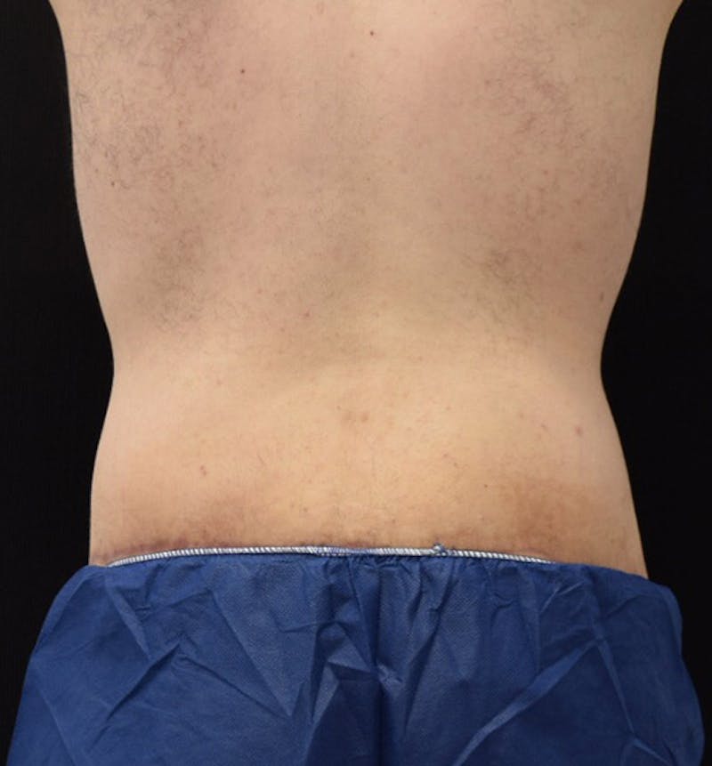 Lower Body Lift Before & After Gallery - Patient 148037520 - Image 12