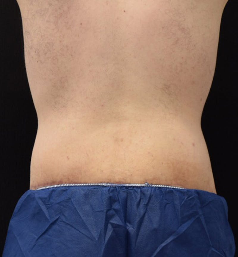 Male Lower Body Lift Before & After Gallery - Patient 148037520 - Image 12