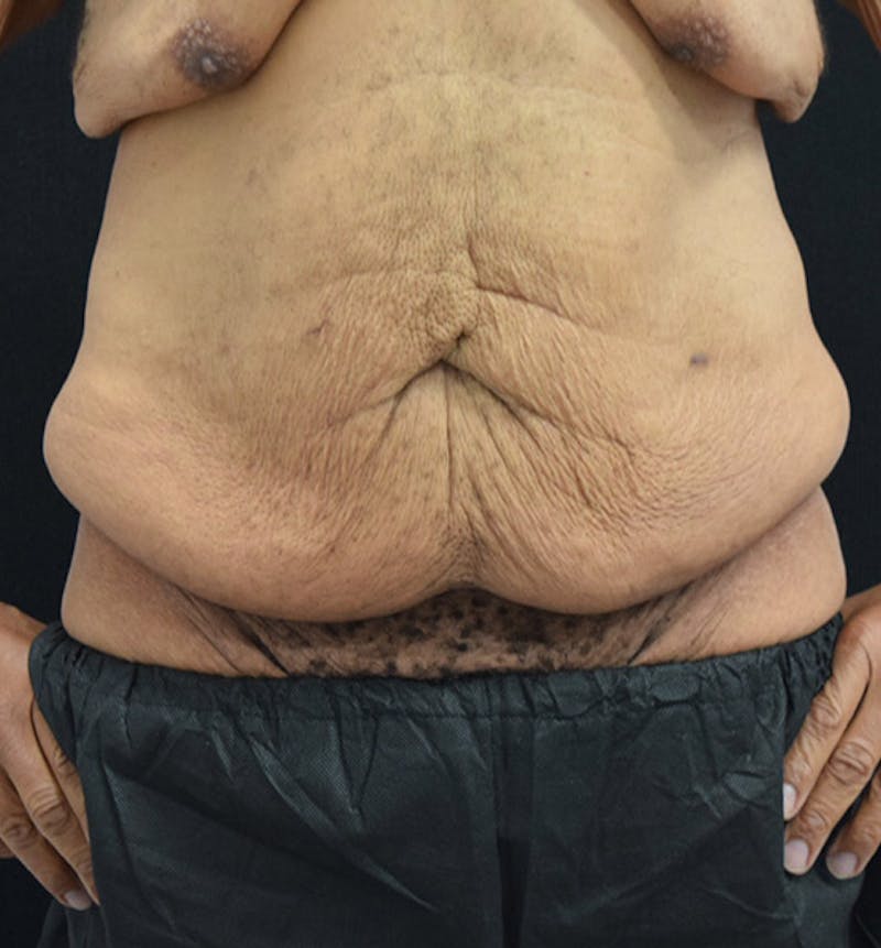 Male Lower Body Lift Before & After Gallery - Patient 148037521 - Image 1
