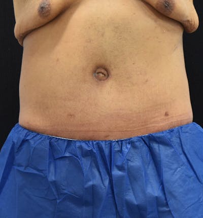 Male Lower Body Lift Before & After Gallery - Patient 148037521 - Image 2