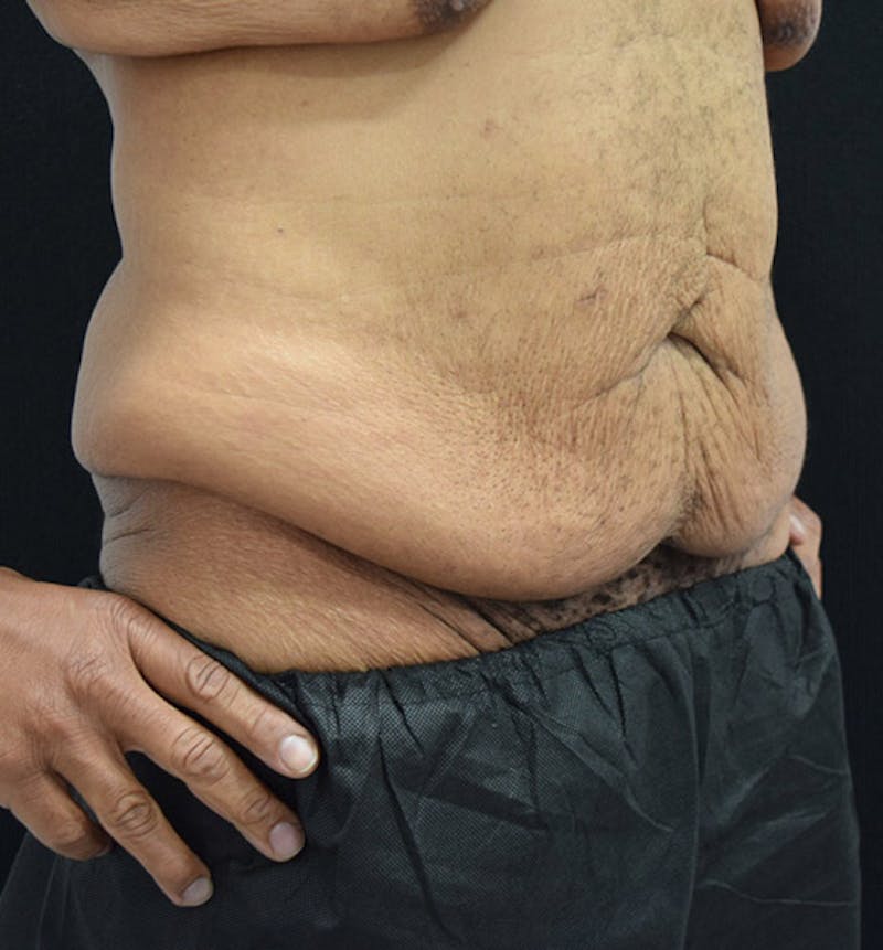 Male Lower Body Lift Before & After Gallery - Patient 148037521 - Image 3