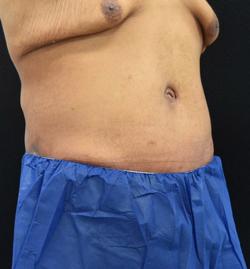 Male Lower Body Lift Before & After Gallery - Patient 148037521 - Image 4