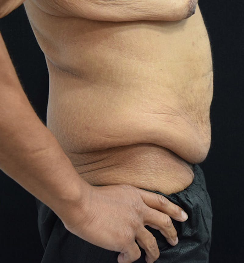 Male Lower Body Lift Before & After Gallery - Patient 148037521 - Image 5