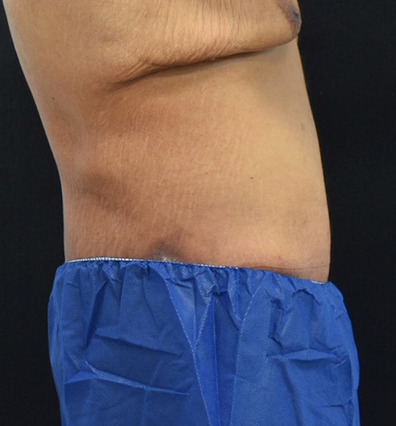 Male Lower Body Lift Before & After Gallery - Patient 148037521 - Image 6