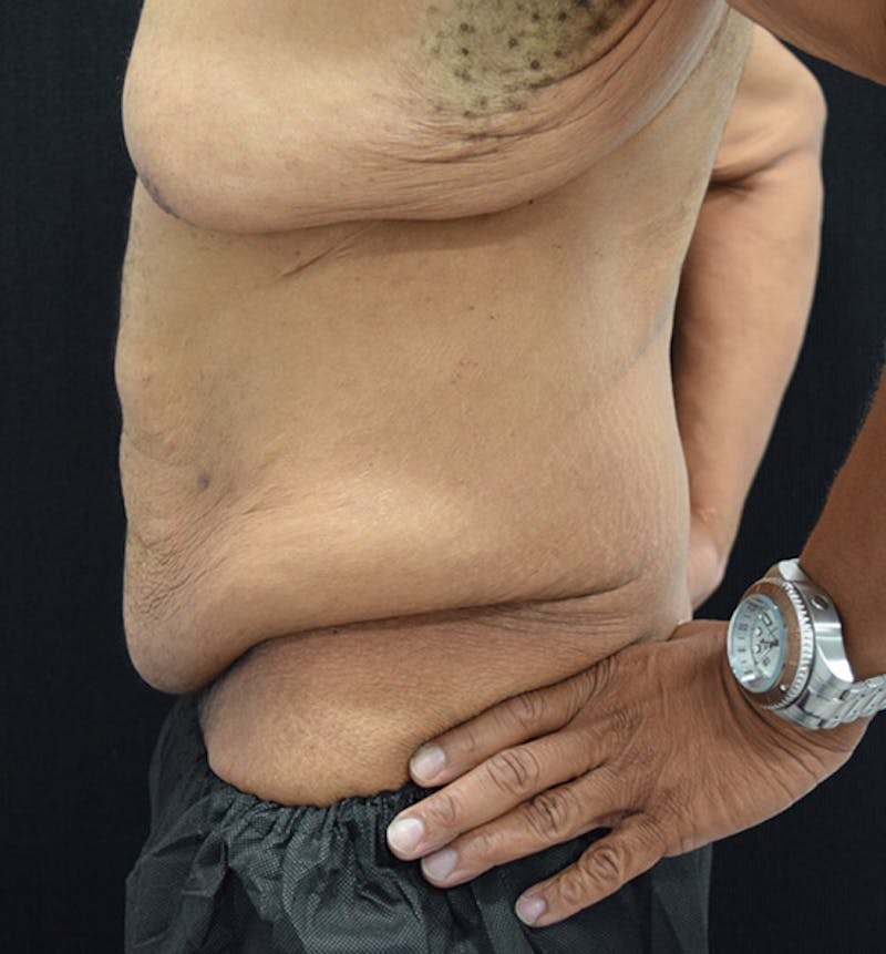 Male Lower Body Lift Before & After Gallery - Patient 148037521 - Image 7