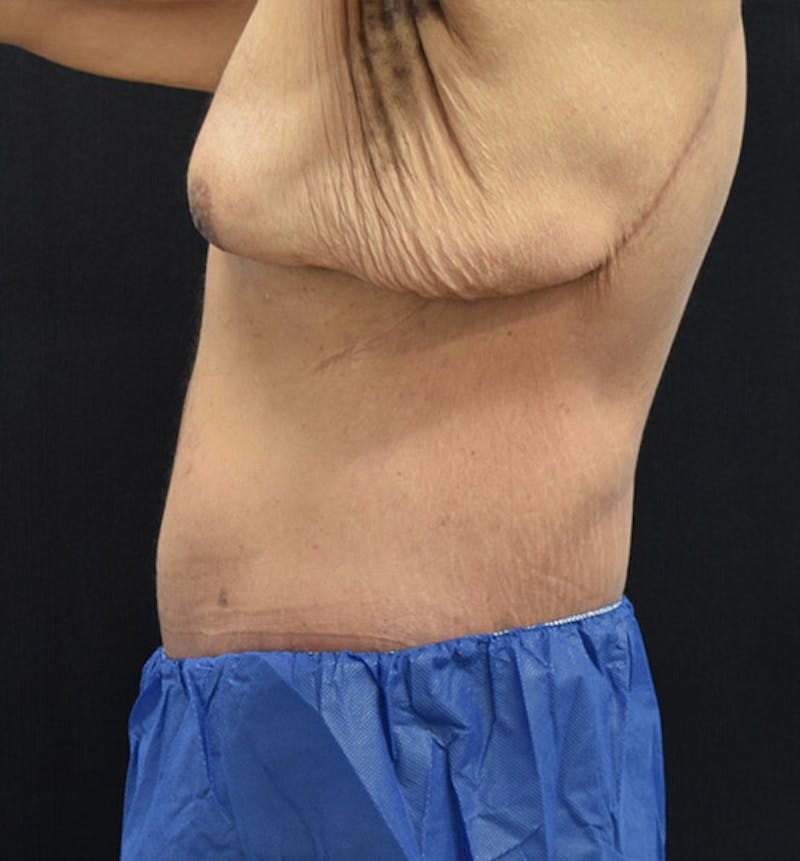 Male Lower Body Lift Before & After Gallery - Patient 148037521 - Image 8