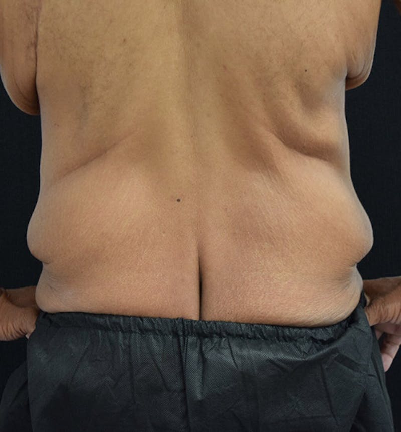 Male Lower Body Lift Before & After Gallery - Patient 148037521 - Image 9