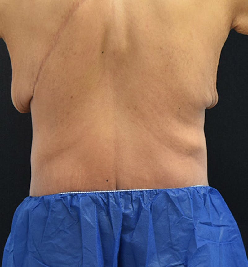 Lower Body Lift Before & After Gallery - Patient 148037521 - Image 10