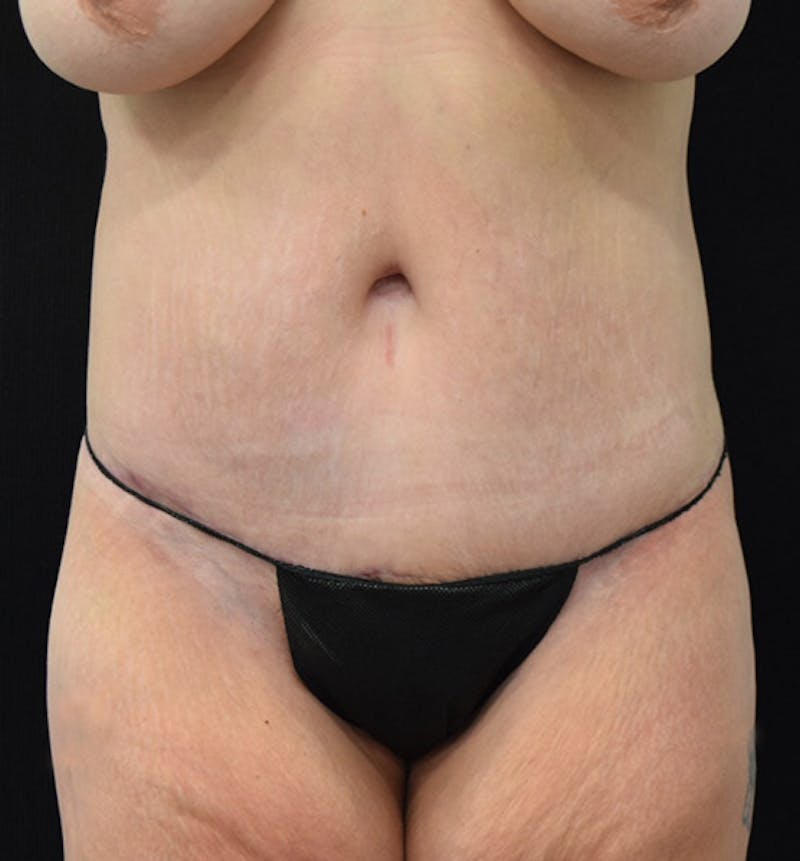 Lower Body Lift Before & After Gallery - Patient 102391445 - Image 2