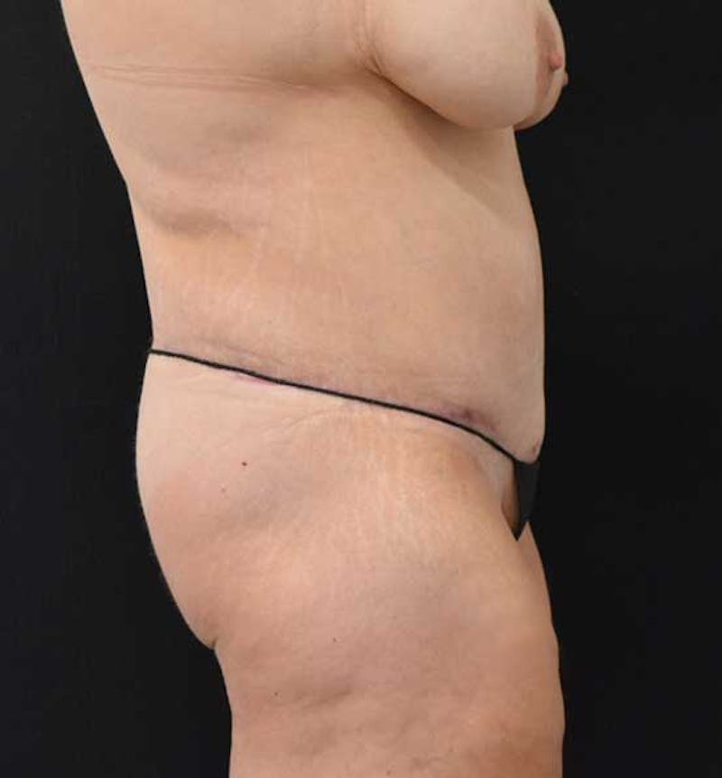 Lower Body Lift Before & After Gallery - Patient 102391445 - Image 4