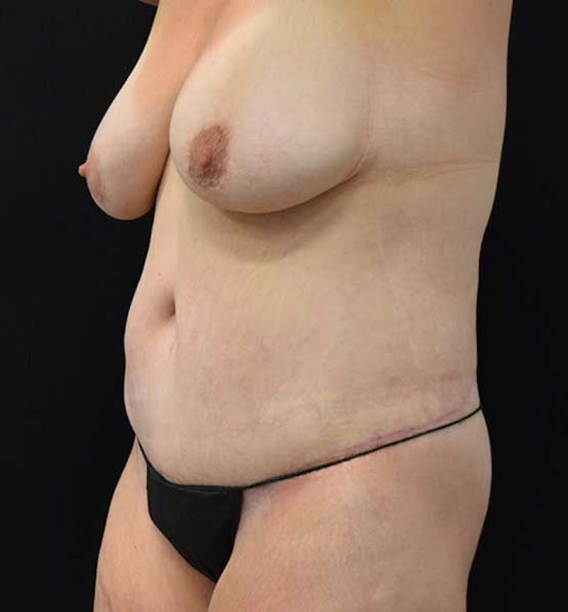Lower Body Lift Before & After Gallery - Patient 102391445 - Image 6
