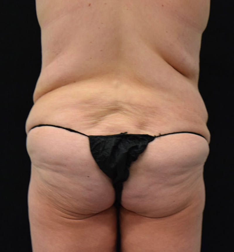 Lower Body Lift Gallery - Patient 102391445 - Image 9