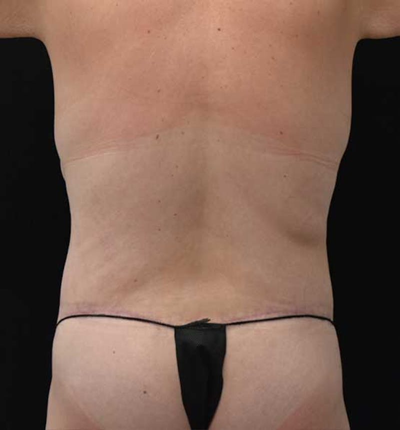 Lower Body Lift Before & After Gallery - Patient 102391445 - Image 10