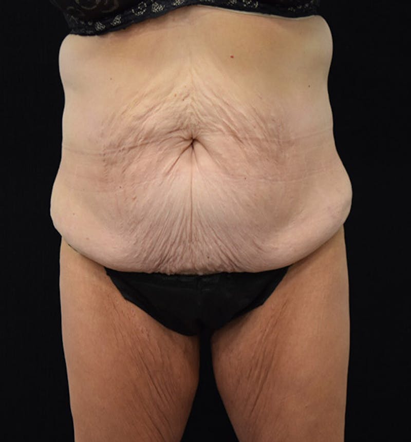 Lower Body Lift Before & After Gallery - Patient 102391460 - Image 1