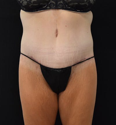 Lower Body Lift Before & After Gallery - Patient 102391460 - Image 2