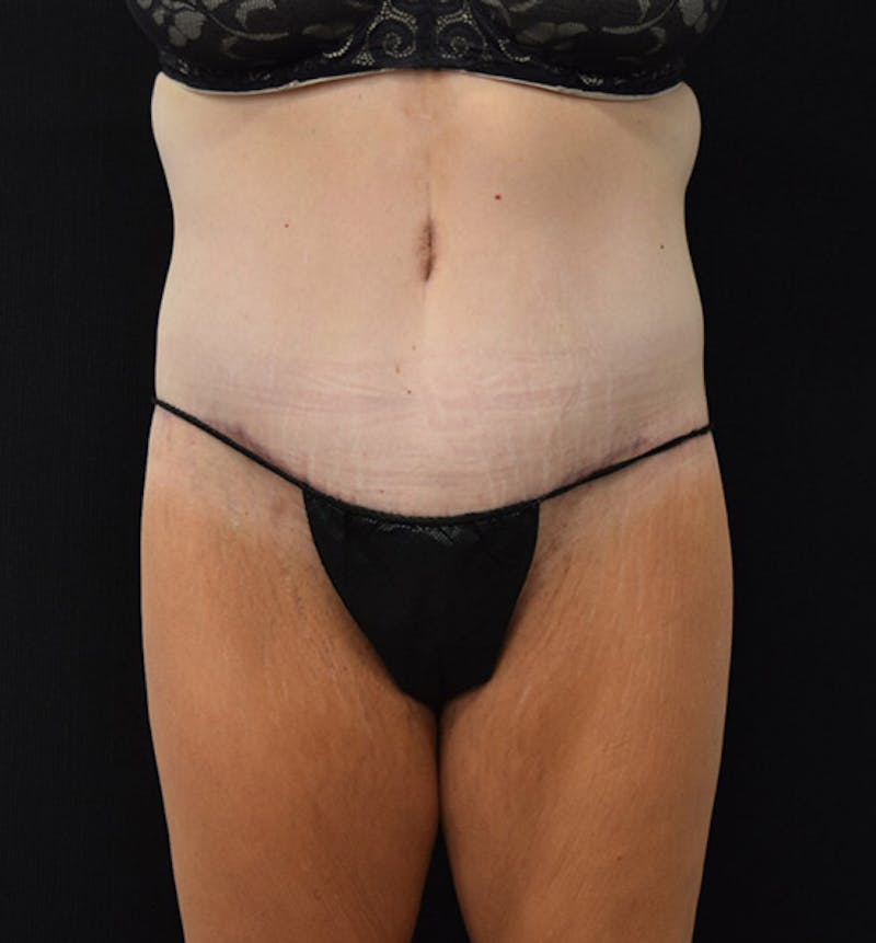 Lower Body Lift Before & After Gallery - Patient 102391460 - Image 2