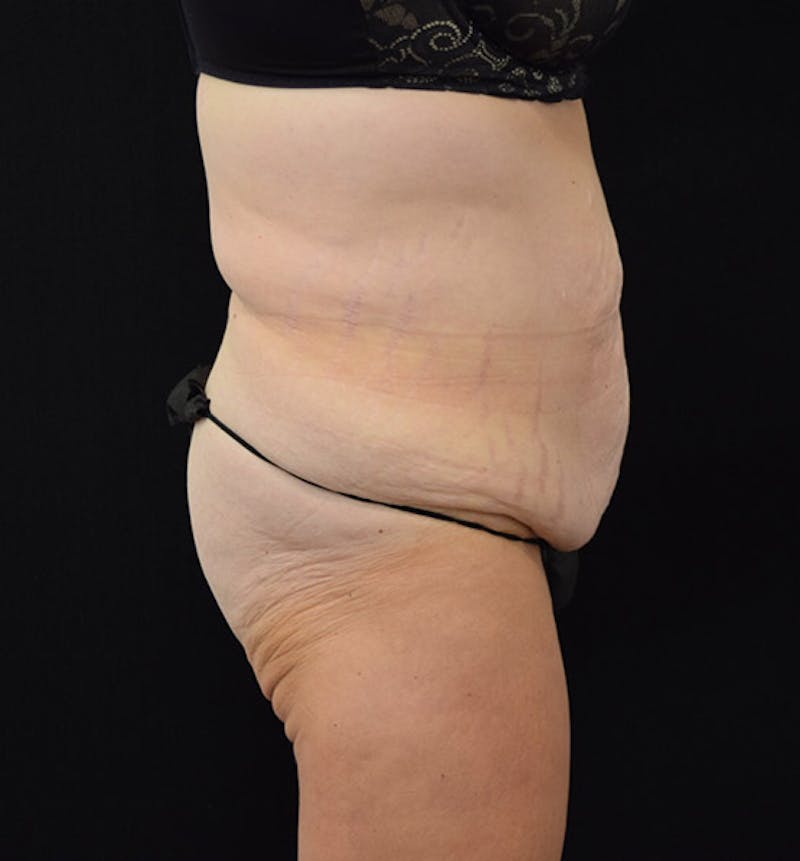 Lower Body Lift Before & After Gallery - Patient 102391460 - Image 3