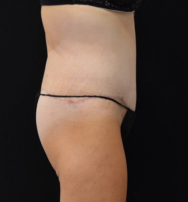 Lower Body Lift Before & After Gallery - Patient 102391460 - Image 4