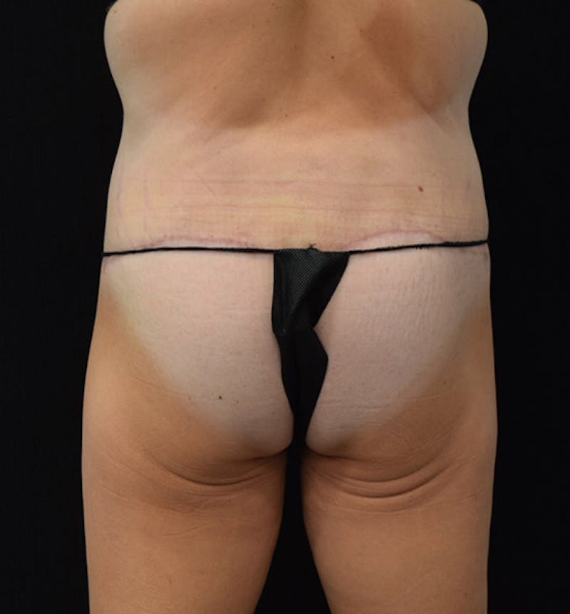 Lower Body Lift Gallery - Patient 102391460 - Image 6