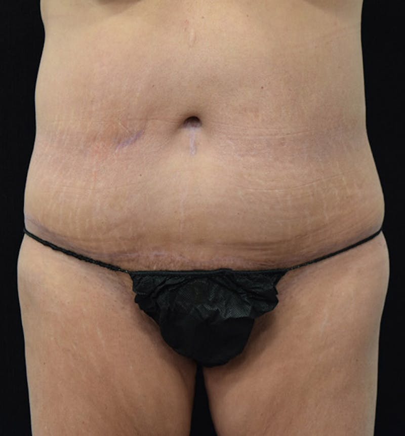Lower Body Lift Before & After Gallery - Patient 102391632 - Image 2