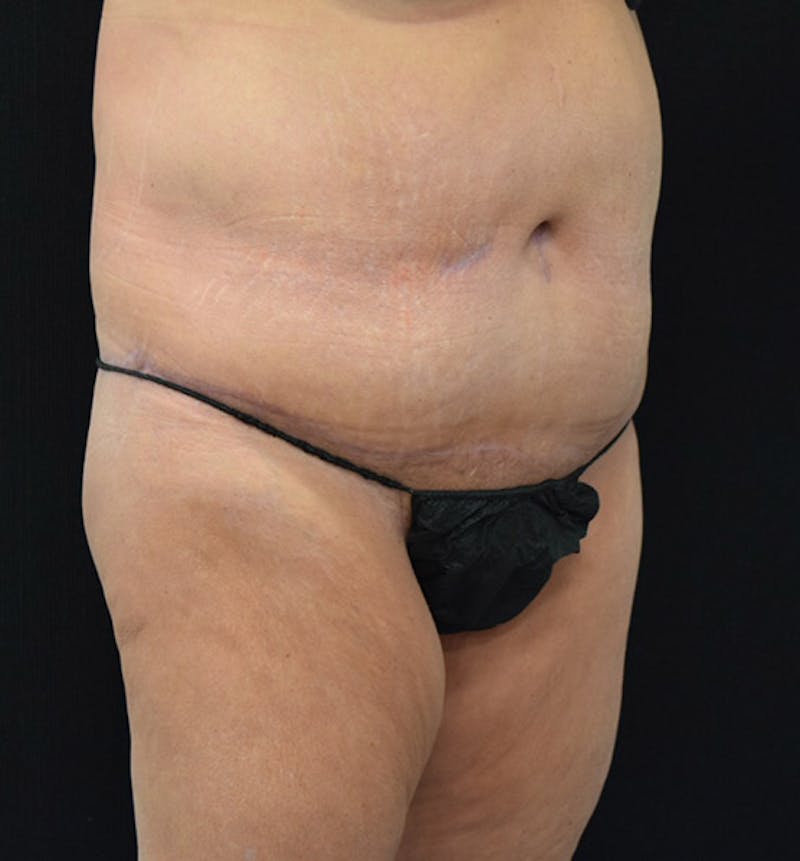 Lower Body Lift Before & After Gallery - Patient 102391632 - Image 4