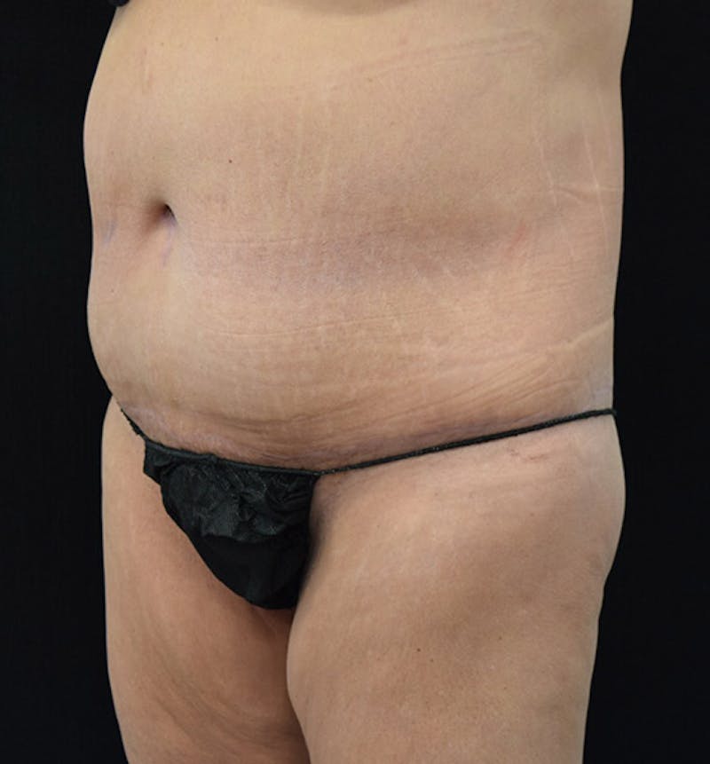 Lower Body Lift Before & After Gallery - Patient 102391632 - Image 8