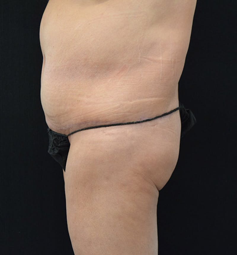 Lower Body Lift Before & After Gallery - Patient 102391632 - Image 10