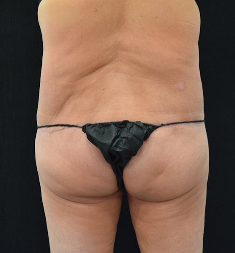 Lower Body Lift Before & After Gallery - Patient 102391632 - Image 12