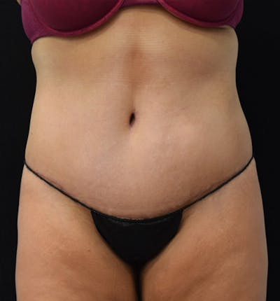 Lower Body Lift Before & After Gallery - Patient 102391826 - Image 2