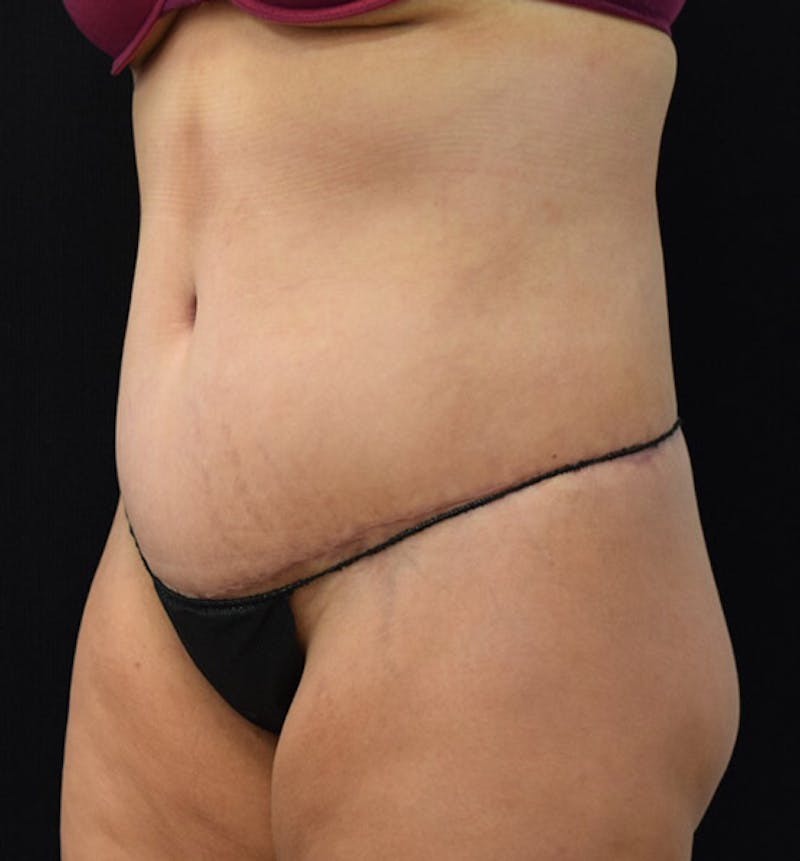 Lower Body Lift Before & After Gallery - Patient 102391826 - Image 4