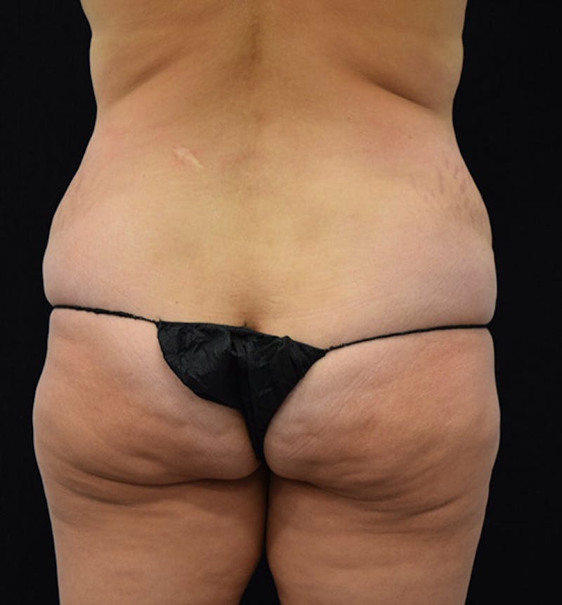 Lower Body Lift Before & After Gallery - Patient 102391826 - Image 5