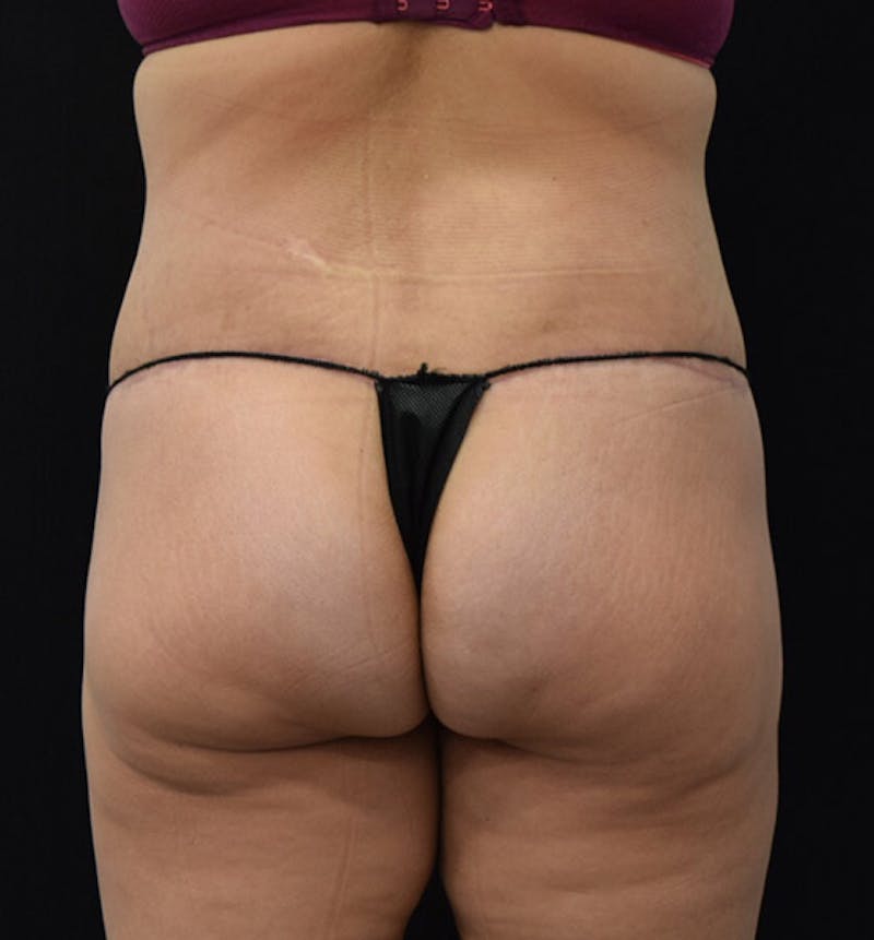 Lower Body Lift Before & After Gallery - Patient 102391826 - Image 6