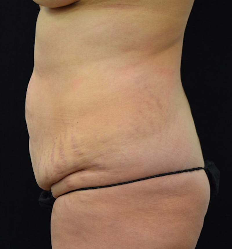 Lower Body Lift Before & After Gallery - Patient 102391826 - Image 7