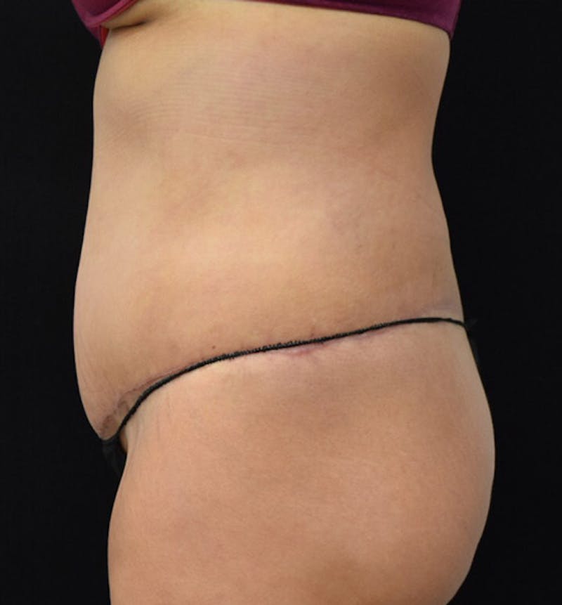 Lower Body Lift Before & After Gallery - Patient 102391826 - Image 8