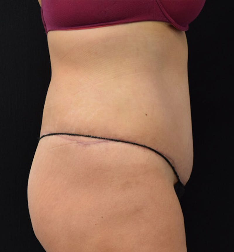 Lower Body Lift Before & After Gallery - Patient 102391826 - Image 10