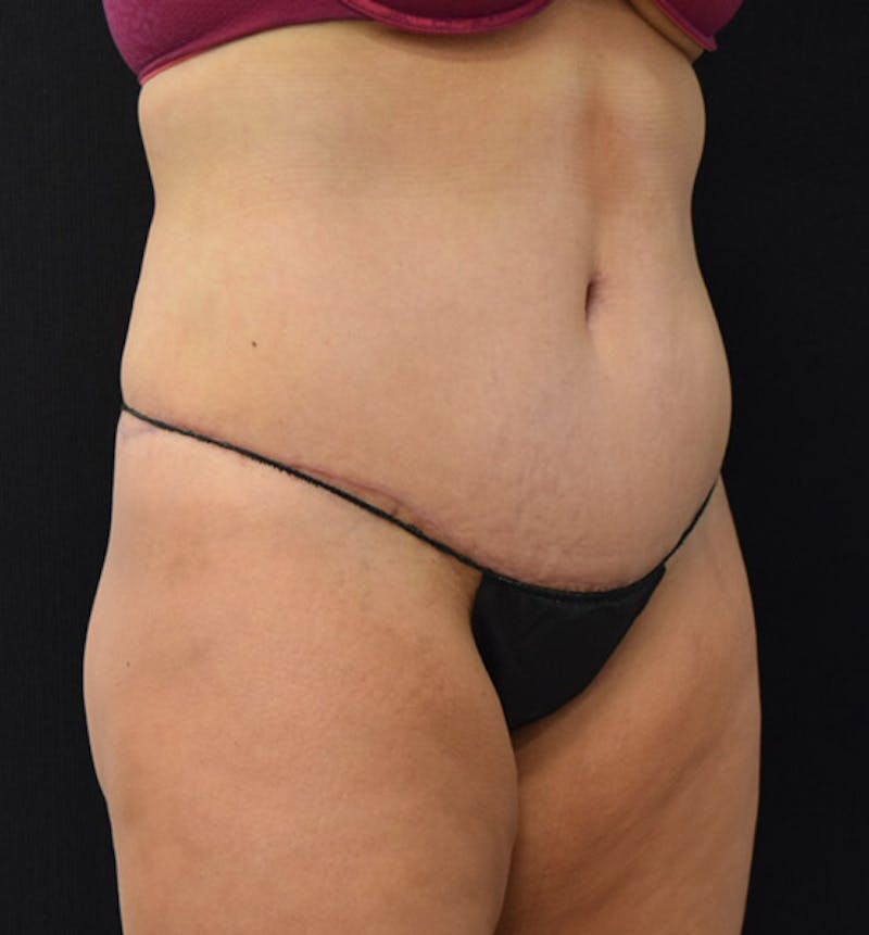 Lower Body Lift Before & After Gallery - Patient 102391826 - Image 12
