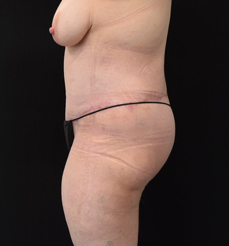 Lower Body Lift Before & After Gallery - Patient 102391920 - Image 6