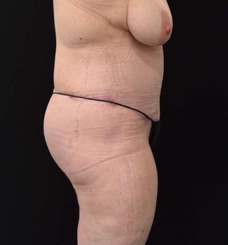 Lower Body Lift Before & After Gallery - Patient 102391920 - Image 10