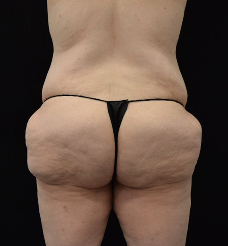 Lower Body Lift Before & After Gallery - Patient 102391920 - Image 11