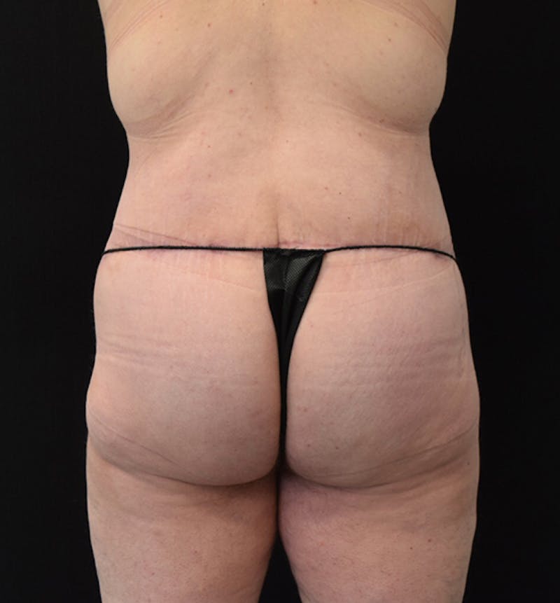 Lower Body Lift Before & After Gallery - Patient 102391920 - Image 12