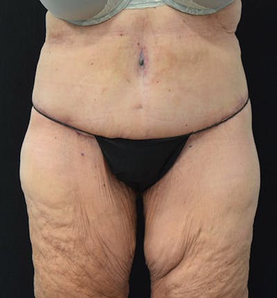Lower Body Lift Before & After Gallery - Patient 102391944 - Image 2