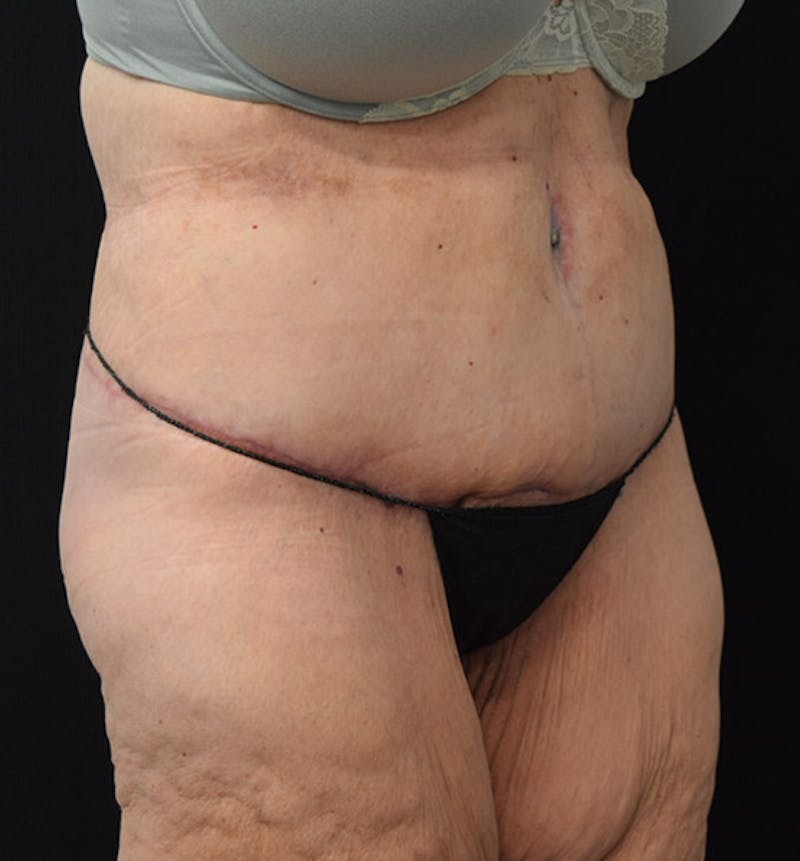 Lower Body Lift Before & After Gallery - Patient 102391944 - Image 4