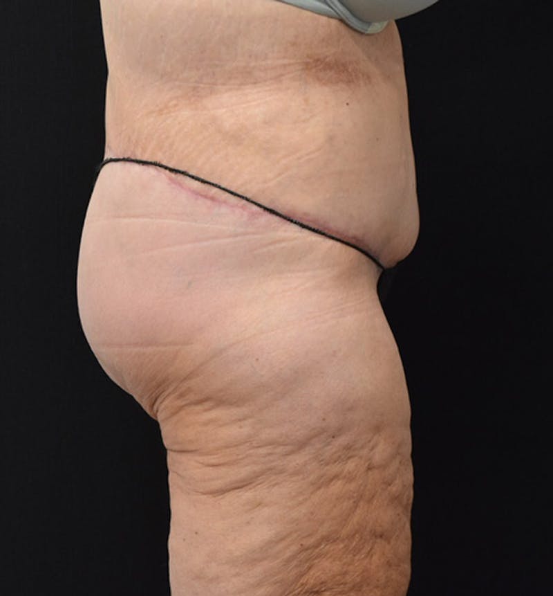 Lower Body Lift Before & After Gallery - Patient 102391944 - Image 6