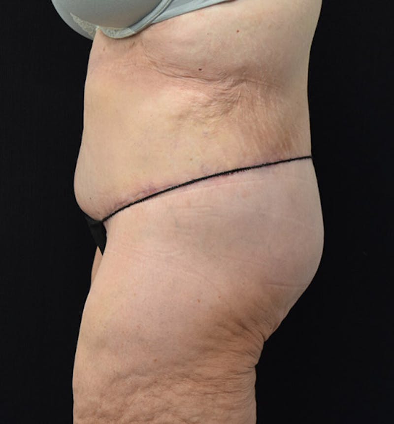 Lower Body Lift Before & After Gallery - Patient 102391944 - Image 10